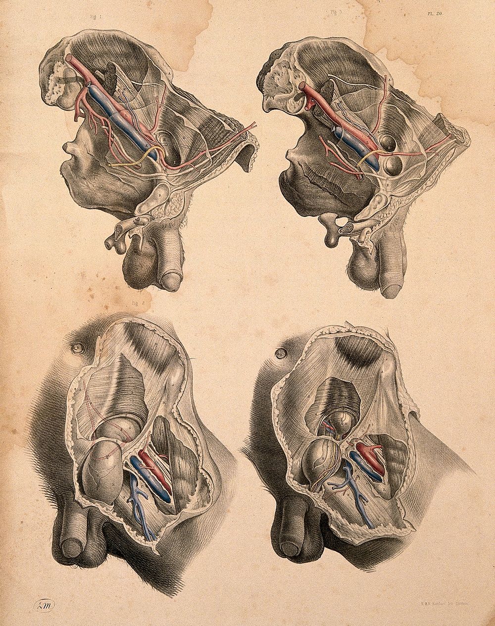 Dissection of the left groin of a man with hernia: four figures. Coloured lithograph by J. Maclise, 1851.