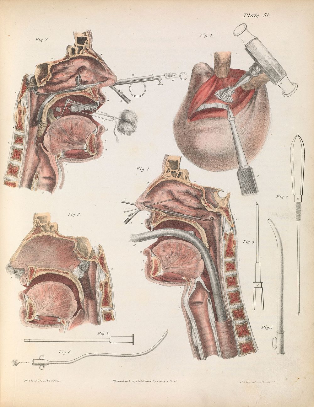 Plate LI. Surgery on the cavities of the face and throat.