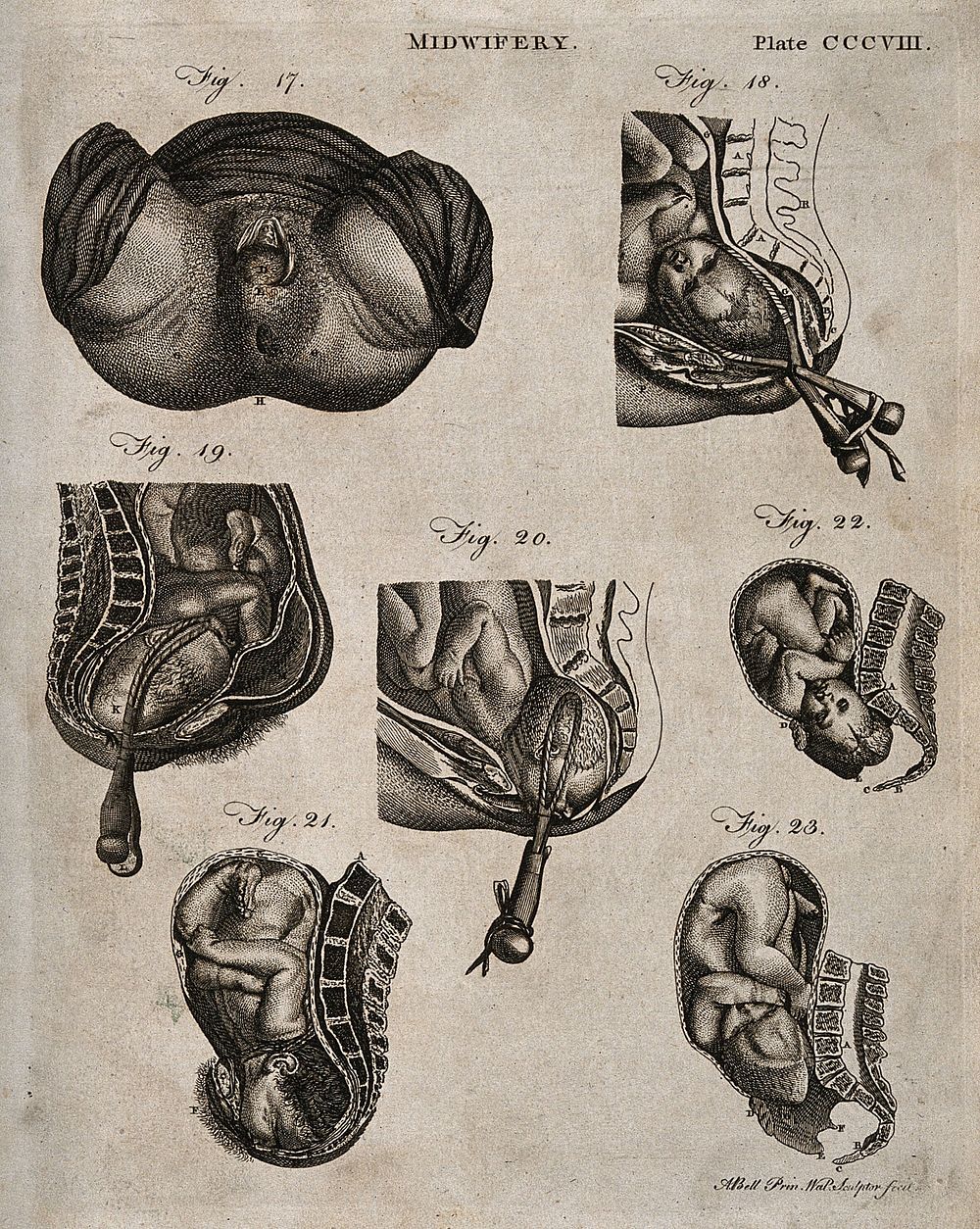 Seven diagrams illustrating the birth of a child with the use of forceps. Engraving by A. Bell.