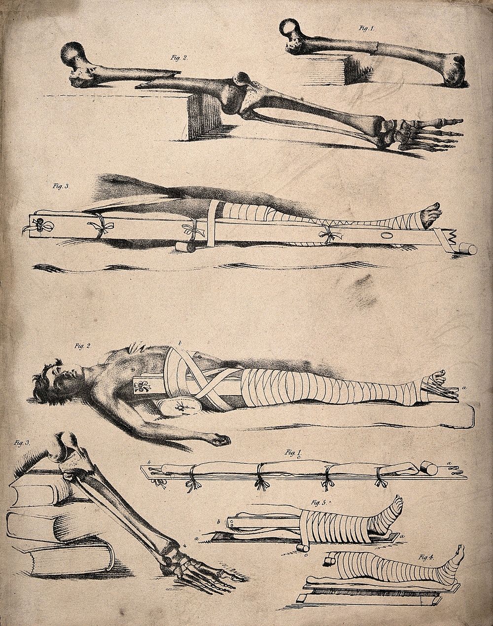 Methods of bandaging a broken leg: eight figures, showing femur and tibia bones broken at various points and the appropriate…