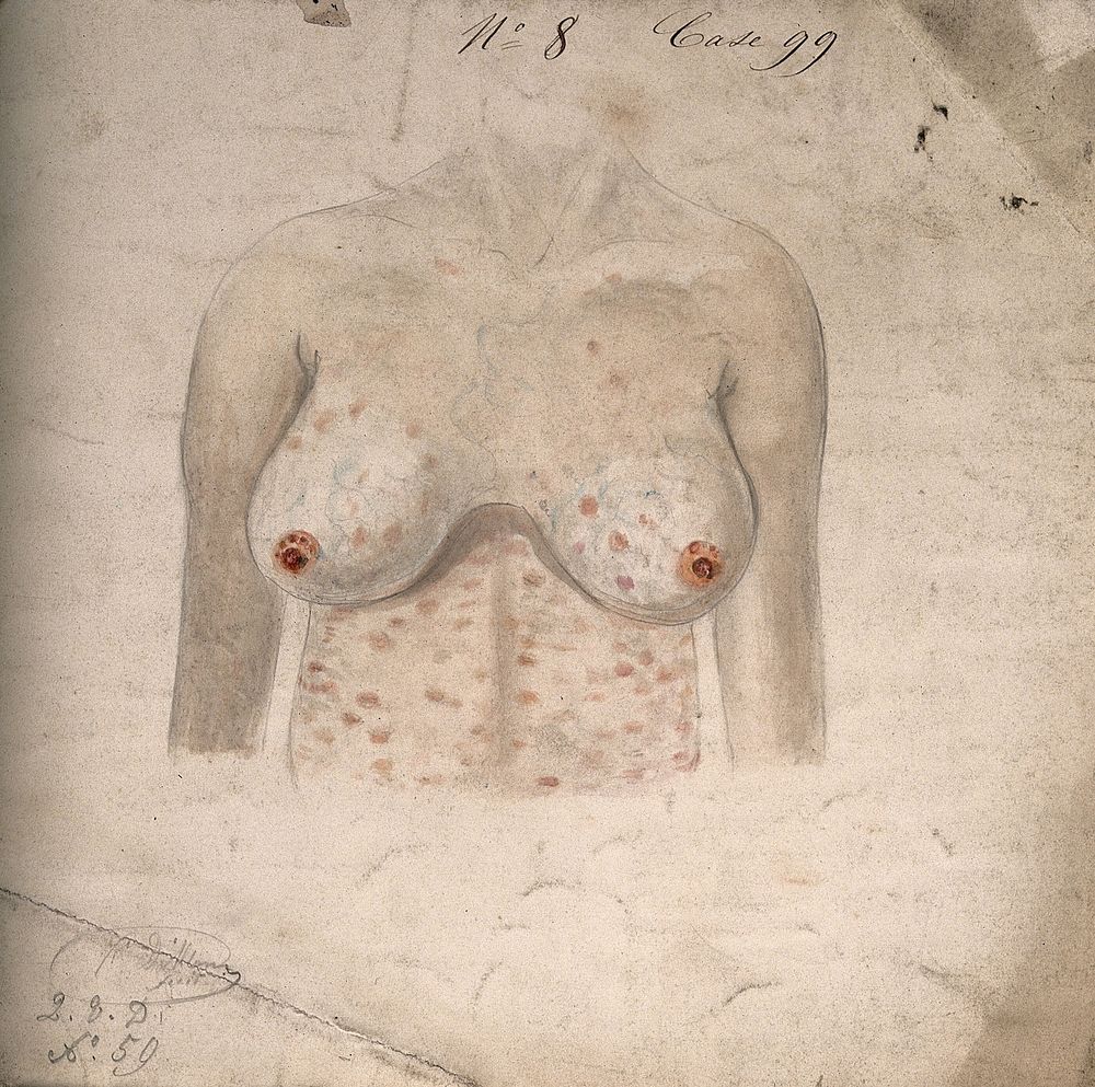 Breasts and chest of a woman suffering from a rash of sores. Watercolour by C. D'Alton, 18--.