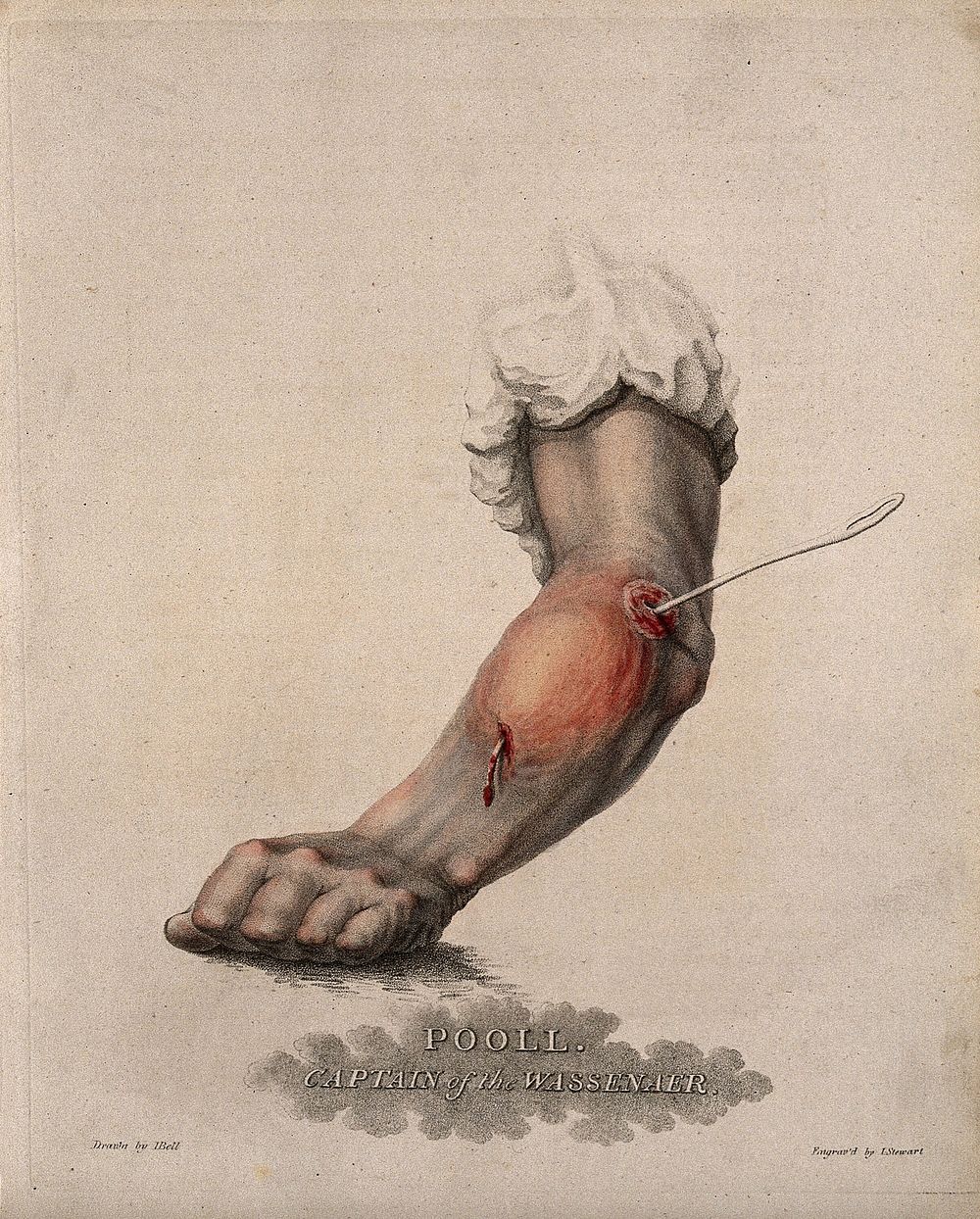 A forearm with a skewer piercing it at the elbow. Coloured stipple etching by L. Stewart after I. Bell, c. 1815 .