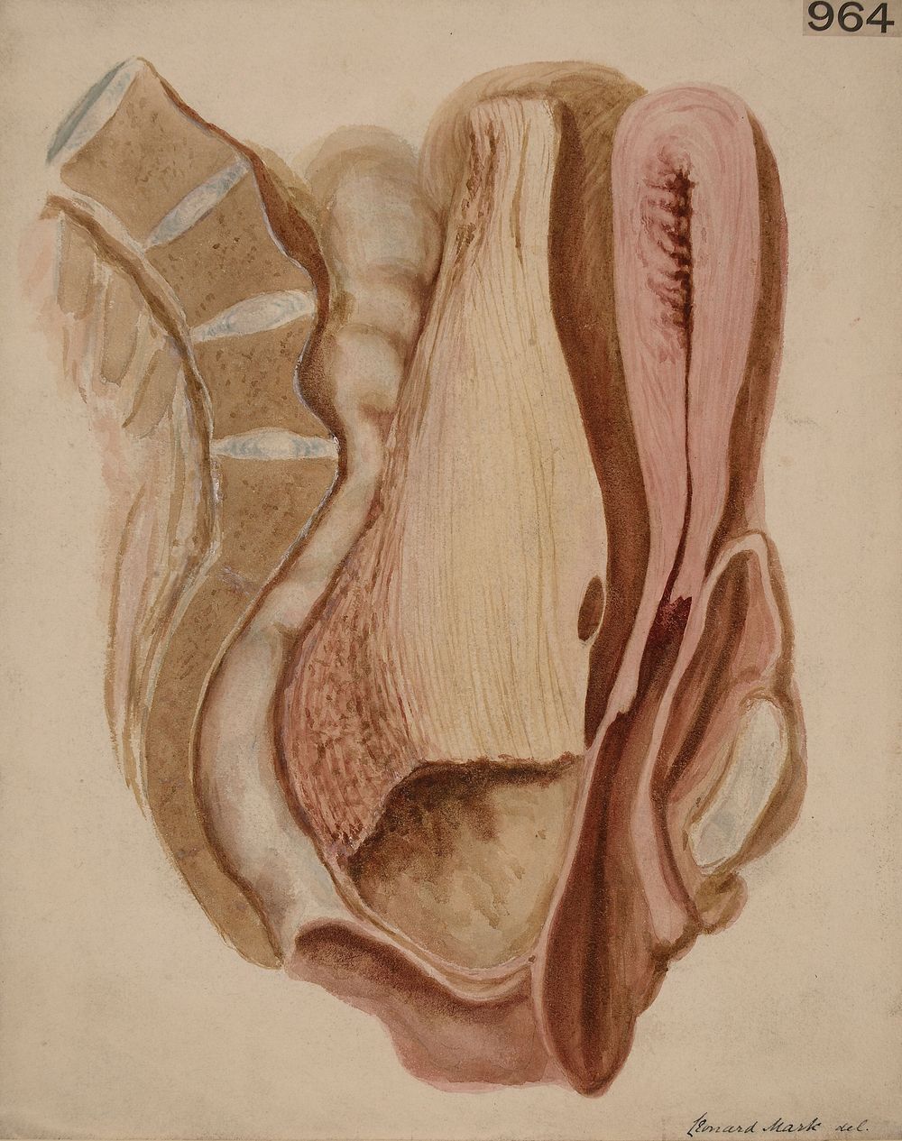 Sagittal section of the pelvis showing a large fibroma of the ovary