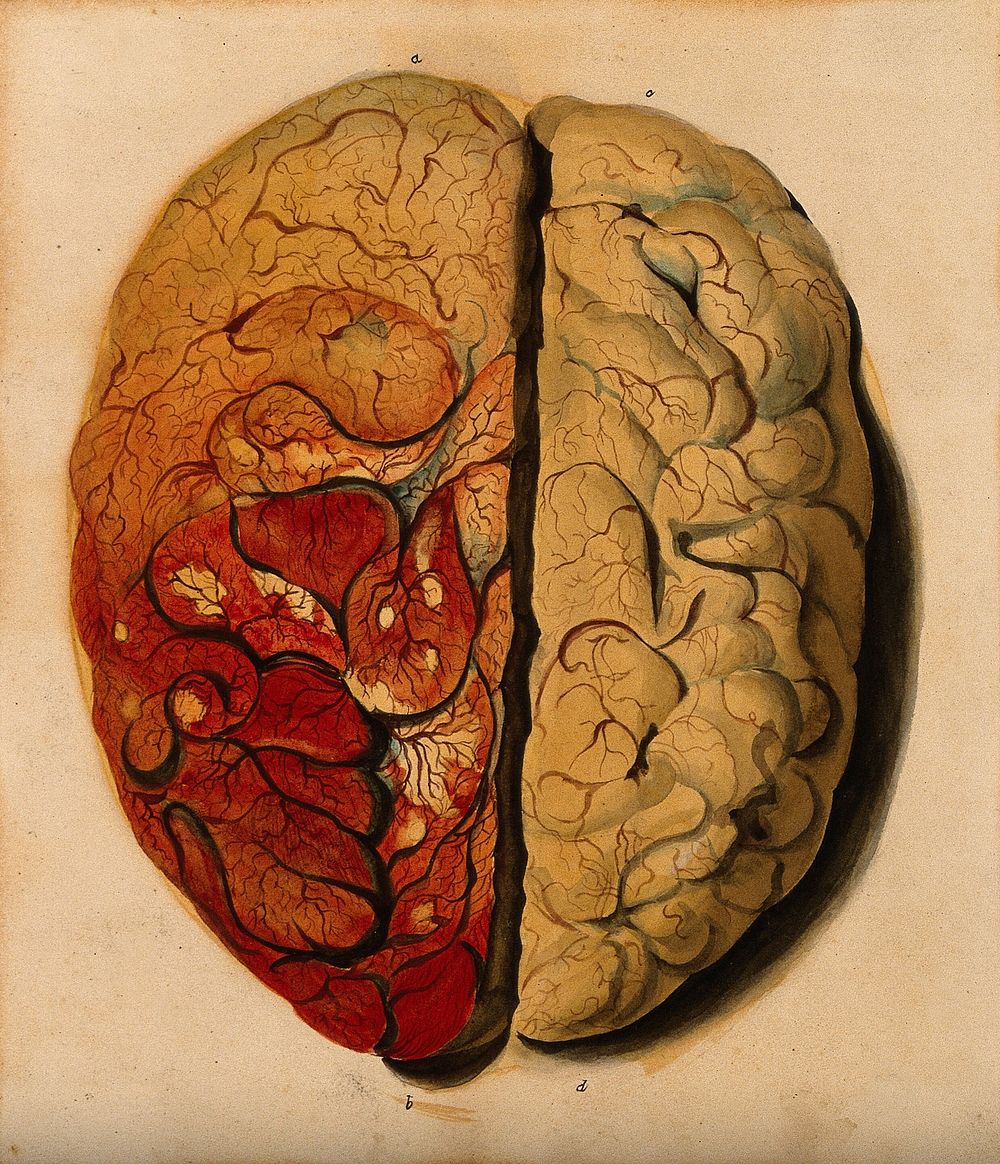 Brain: view from above, showing the gyri, with one hemisphere covered with pia mater. Watercolour with varnish , ca. 1826.