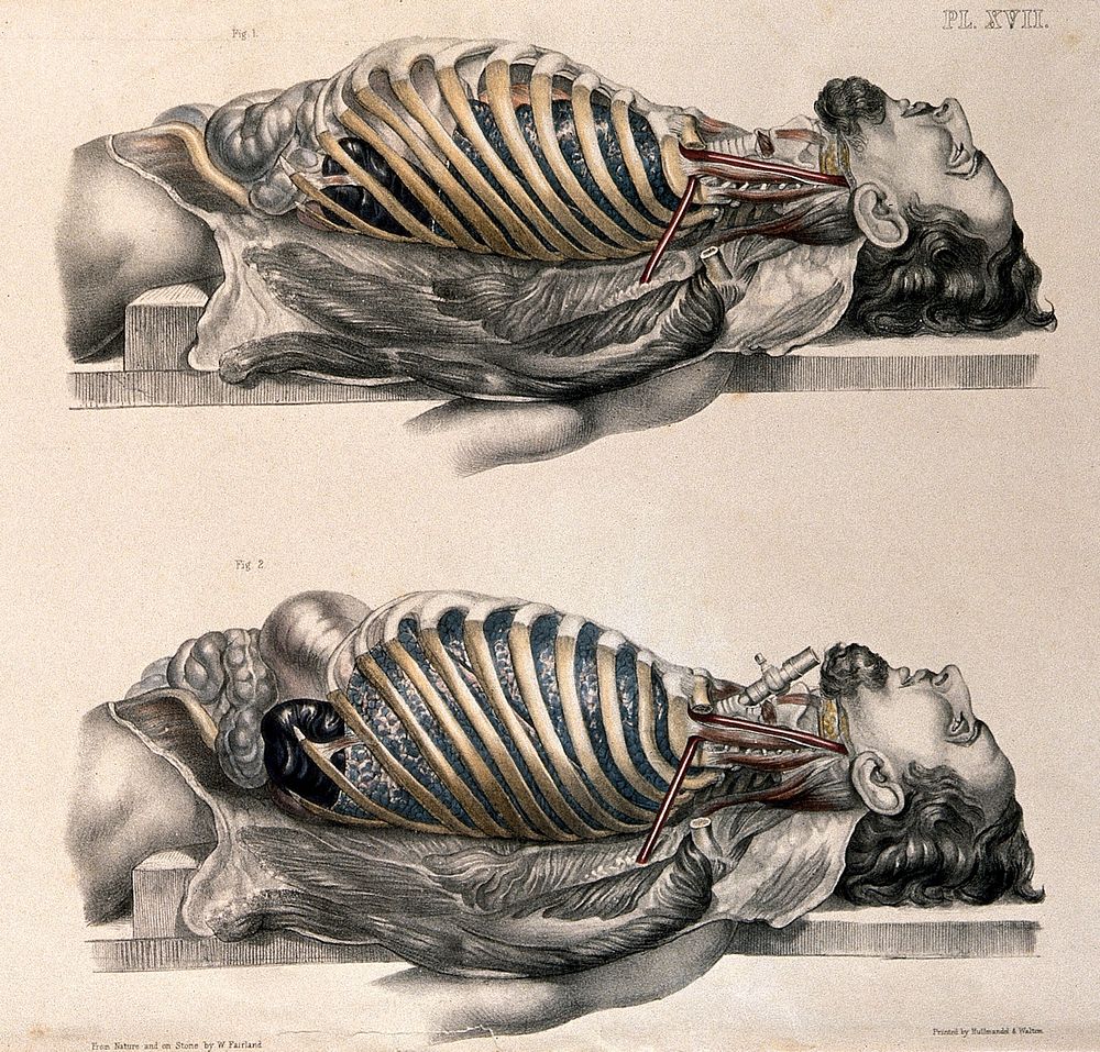 The body of a man lying down with the trunk dissected: two figures showing the lungs after breathing out (above) and after…