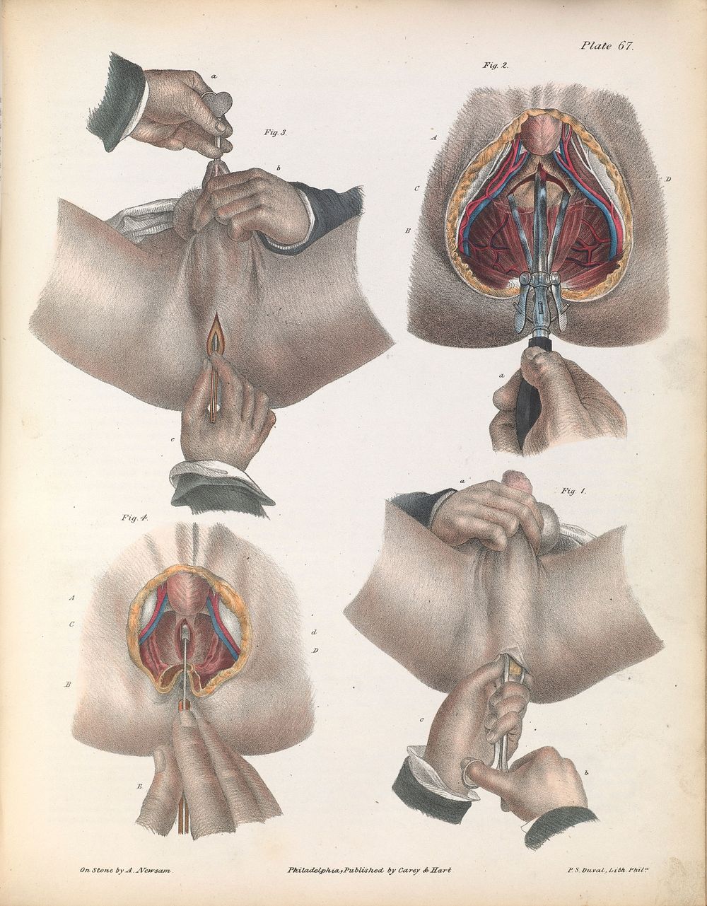 Plate LXVII. Surgical technique for lithotomy.