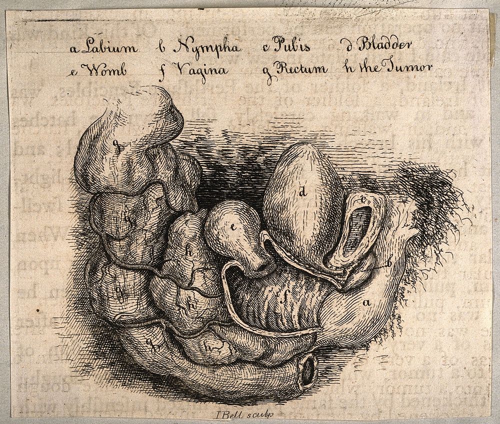 The female reproductive and urinary systems with a tumor. Etching by J. Bell.