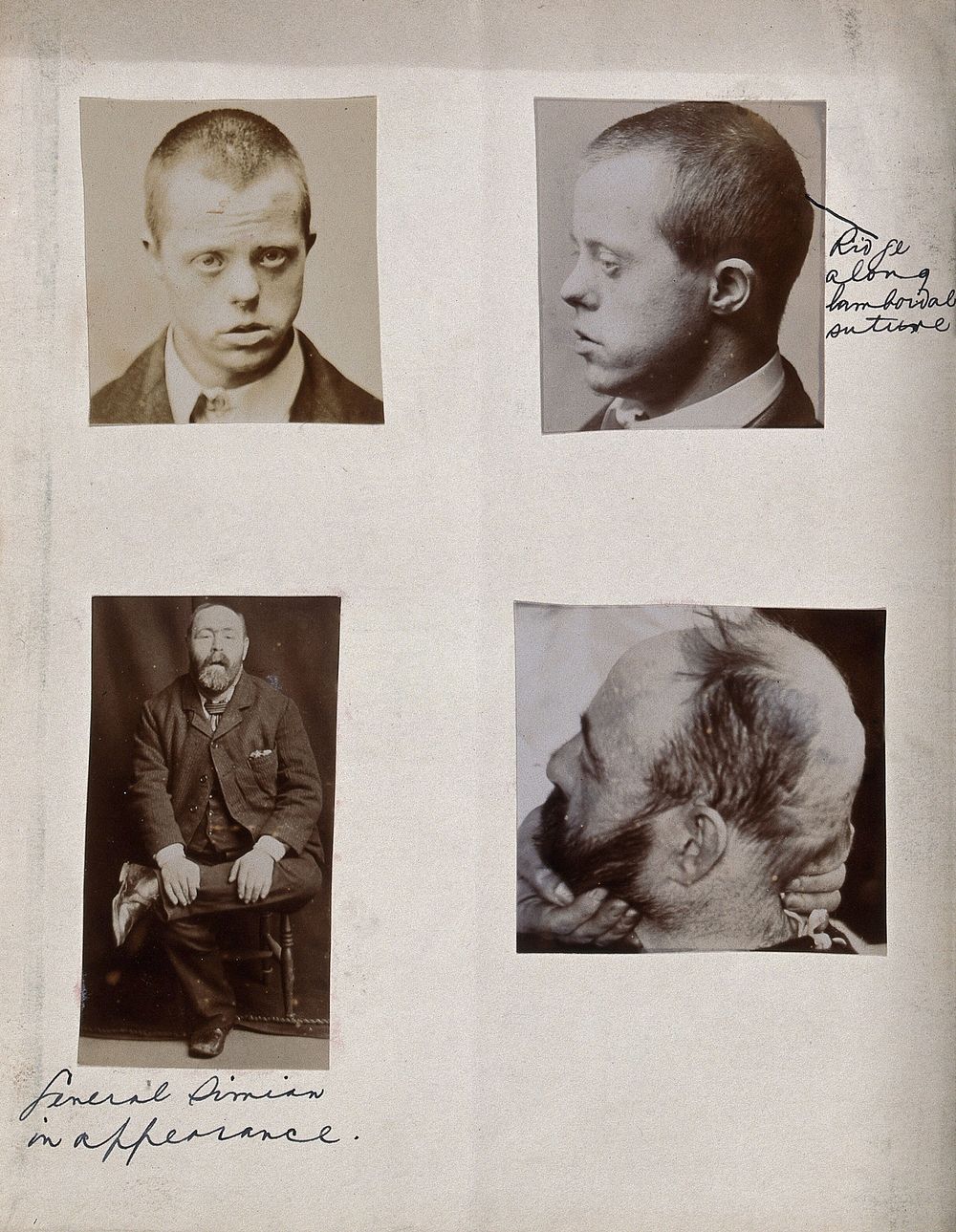 Down's syndrome: seen in two views of a man's head. Two photographs.