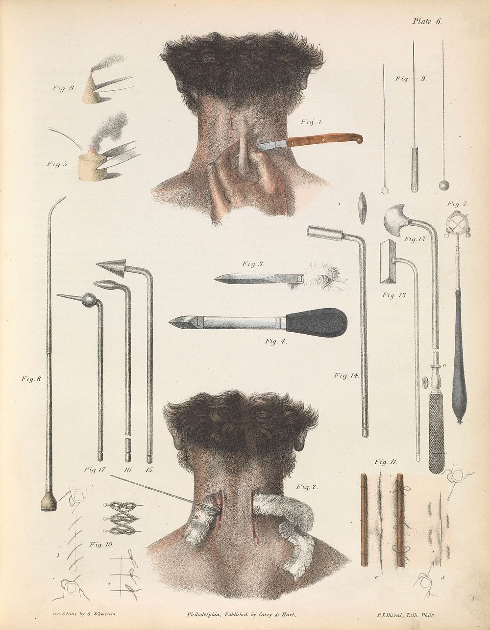 Plate VI. Various instruments and techniques used in surgery. Illustration of seton, moxa, acupuntcture needles, sutures…