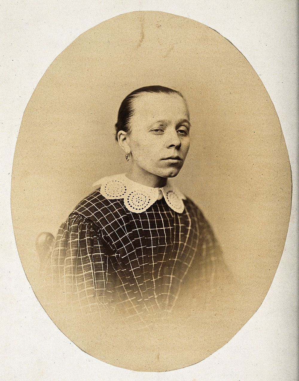 A woman, head and shoulders, viewed from the front; her eyelids are uneven. Photograph by L. Haase after H.W. Berend, 1863.