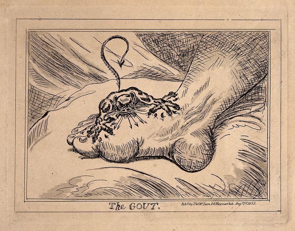 A swollen and inflamed foot: gout is represented by an attacking demon. Etching, 1835, after J. Gillray, 1799.