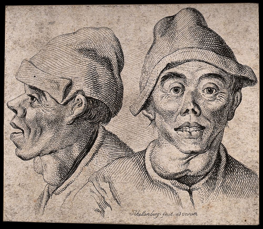 A man with goitre: front (left) and profile (right) views. Etching by J.R. Schellenberg, 1778.
