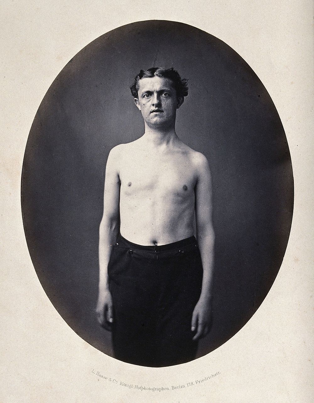 A partially clothed man, standing, viewed from the front; his left shoulder appears slightly small. Photograph by L. Haase…
