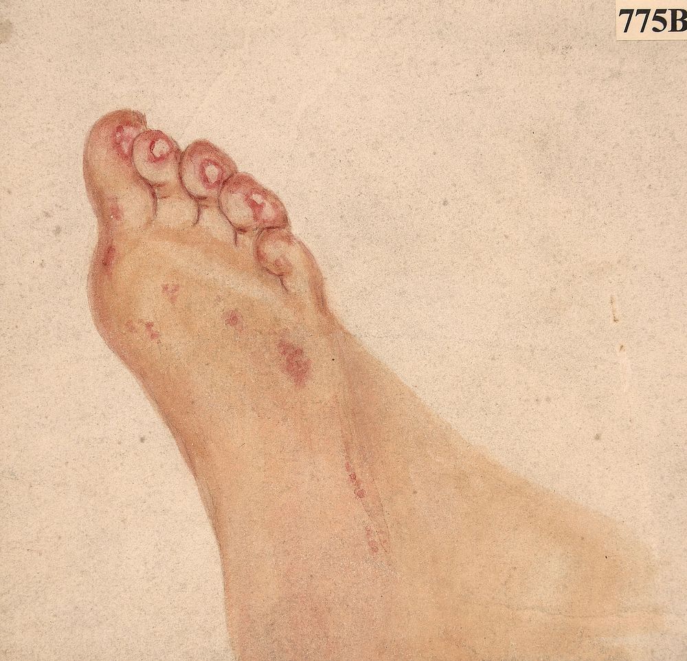 Foot of a girl with a peculiar ulcerative affection of the skin