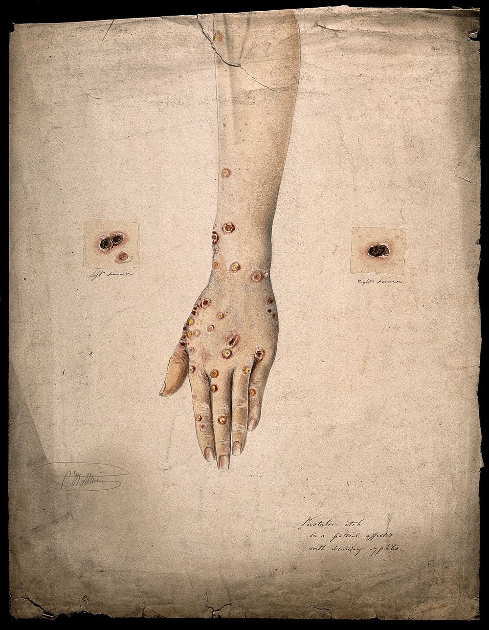 Sores and pustules on the hand and arms of a woman suffering from secondary syphilis. Watercolour by C. D'Alton, 1858.