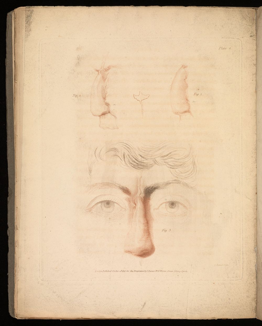 An account of two successful operations for restoring a lost nose from the integuments of the forehead in the cases of two…