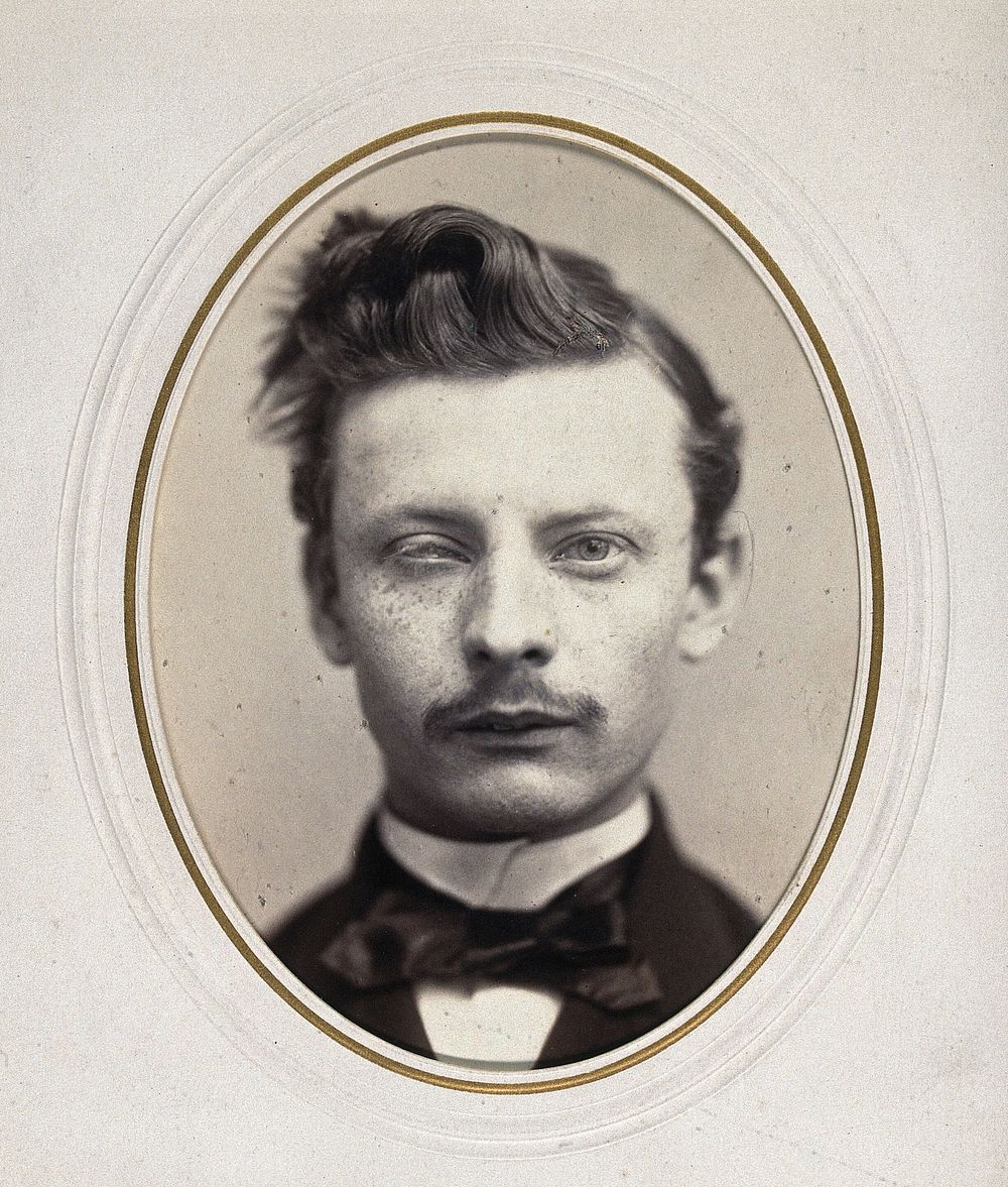 A man's head; his left eye is smaller than his right. Photograph by L. Haase after H.W. Berend, 1865.