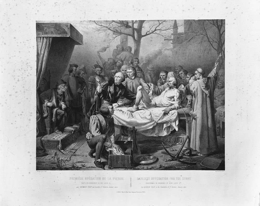 Germain Colot performing an operation for bladder stone. Lithograph by A. Rivoulon, 1851.