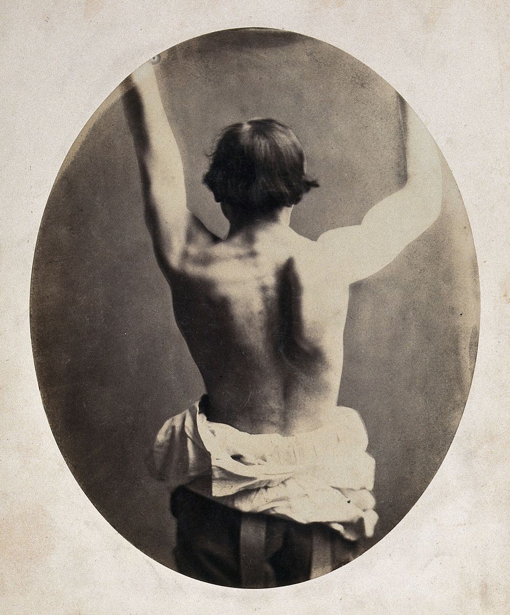 A man, viewed from the back, unclothed to his waist and raising his arms; with protuberance on right shoulder. Photograph by…