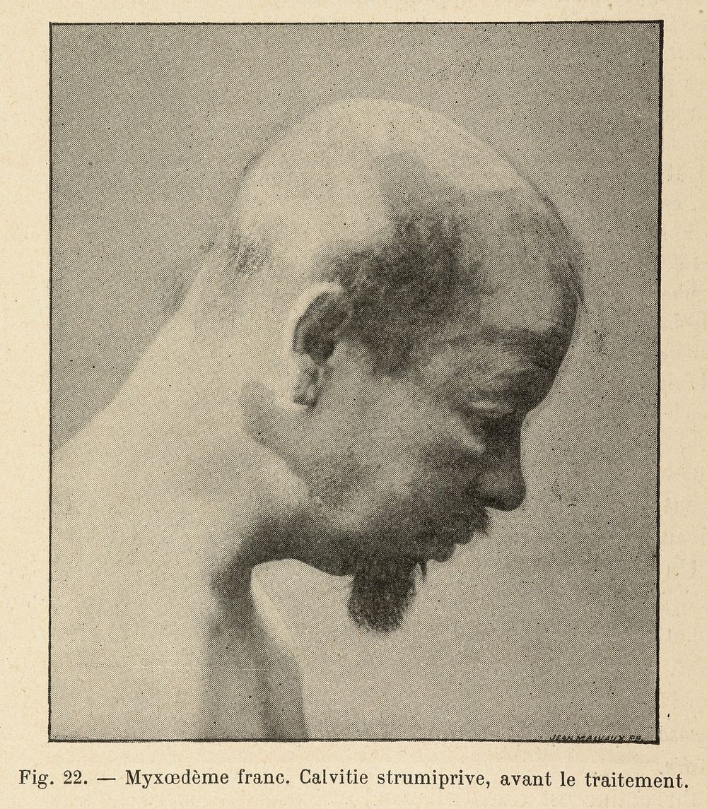 Male figure with myxedema, after treatment. Caption: 'Myxoedeme franc. Calvitie strumiprive, avant le traitement'