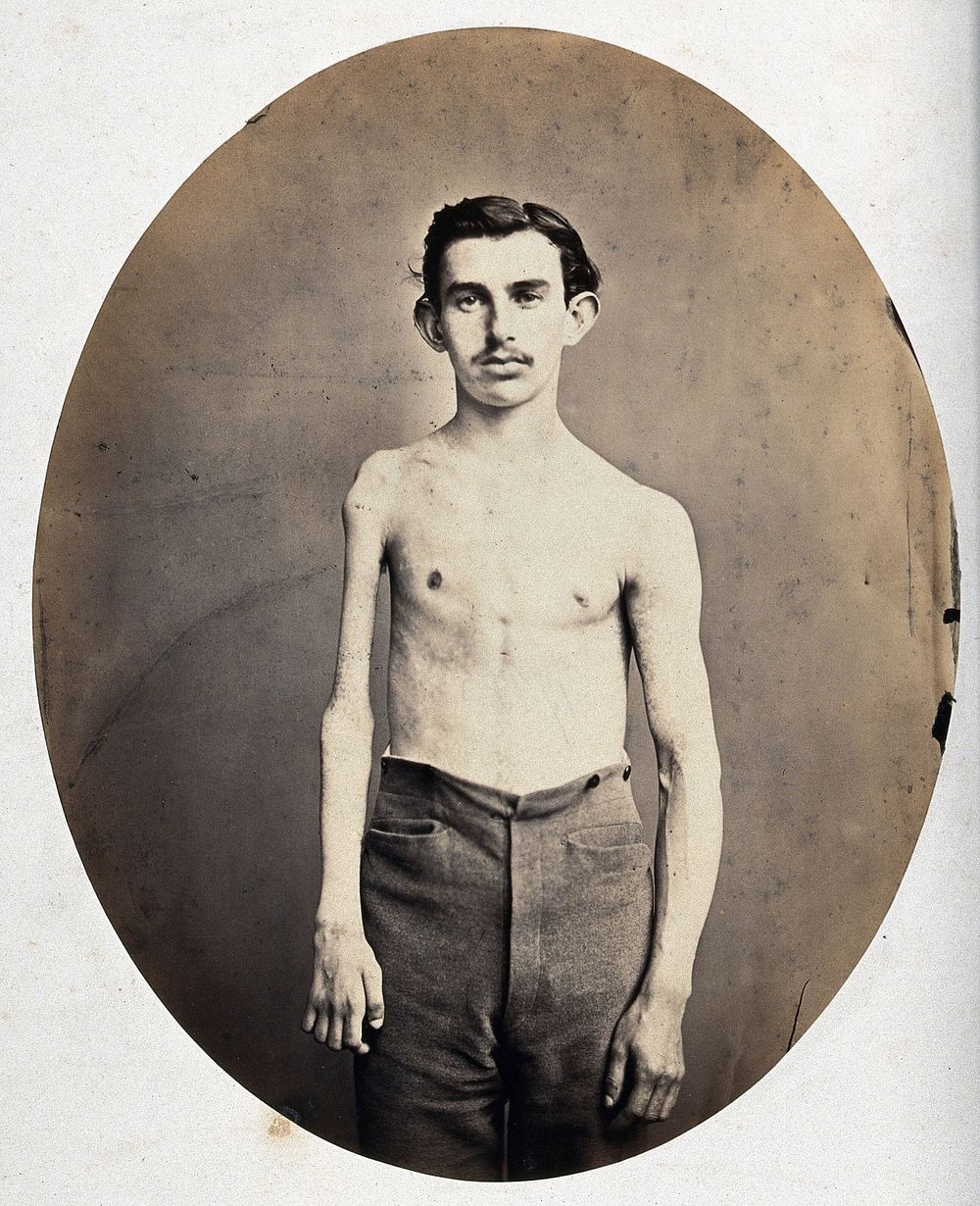 A partially clothed man, standing, viewed from the front; his right arm and shoulder appear severely deformed. Photograph by…