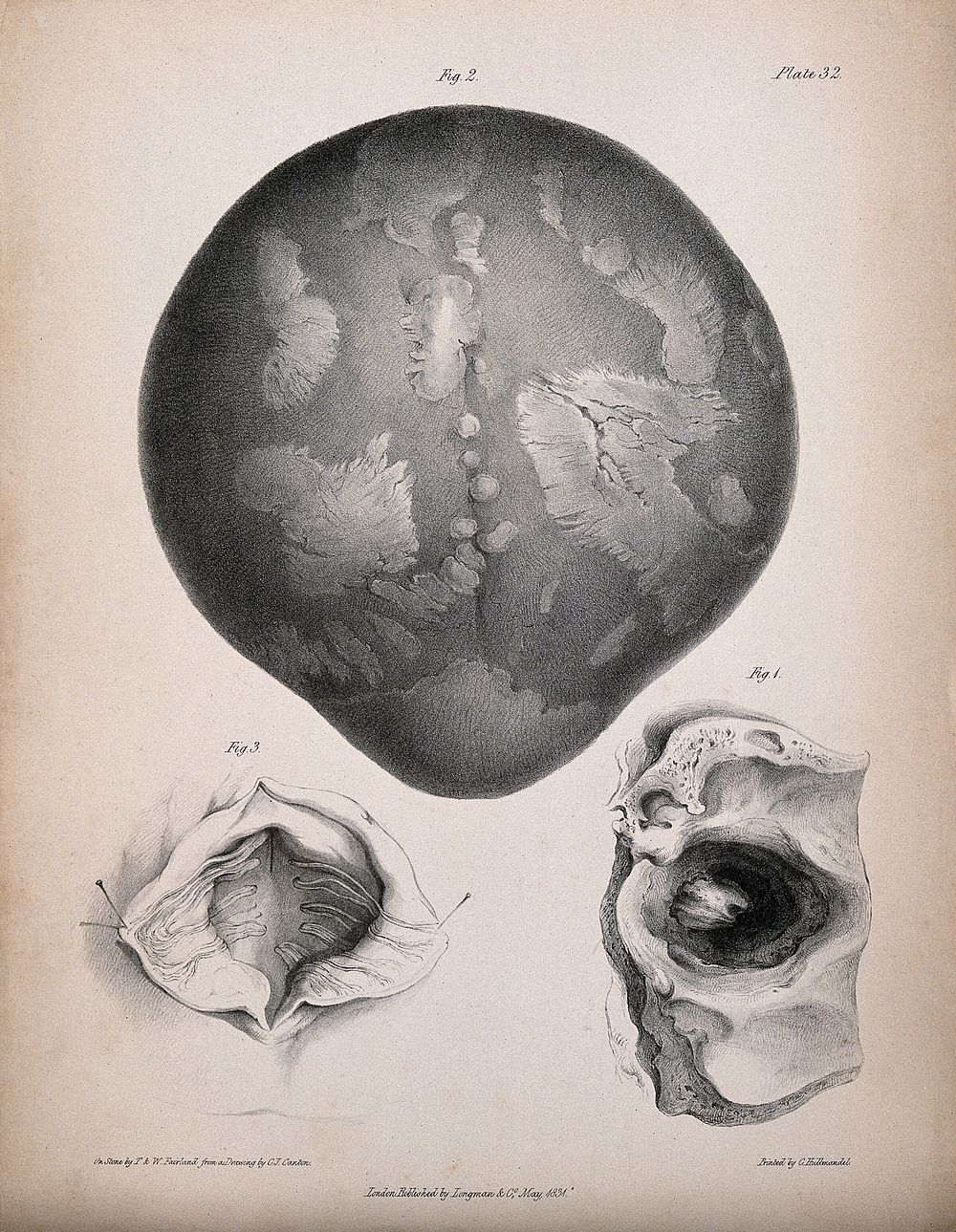 A diseased brain; and two sections of spine. Lithograph by T. & W. Fairland after C. J. Canton for Richard Bright, 1831.