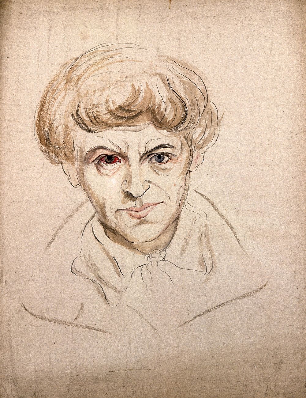 Head of a man with a disease affecting his eye. Watercolour by Christopher D' Alton, 1857.