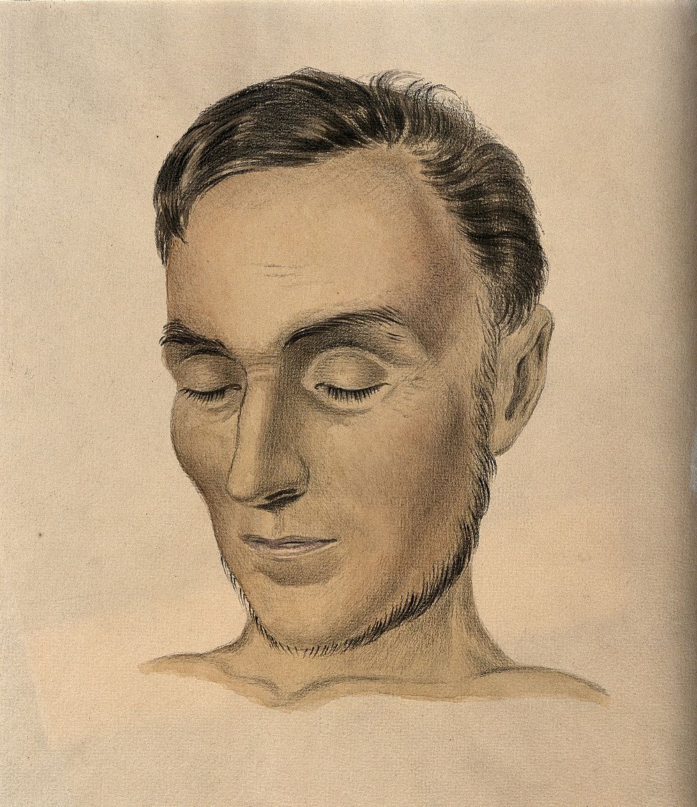 Face of a man suffering from Addison's disease. Watercolour with chalk, 1849.