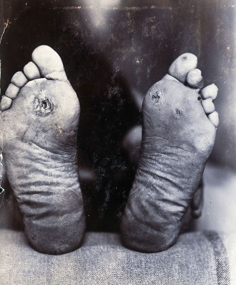 Friern Hospital, London: the soles of the feet of a lying figure. Photograph, 1890/1910.