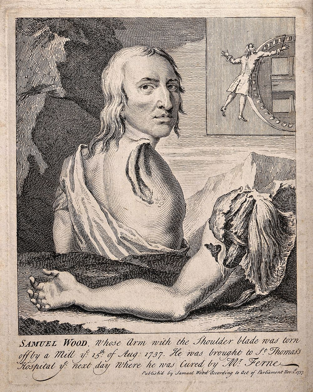 Samuel Wood, a man whose shoulder and arm were torn off in an accident at a mill. Engraving, 1737.