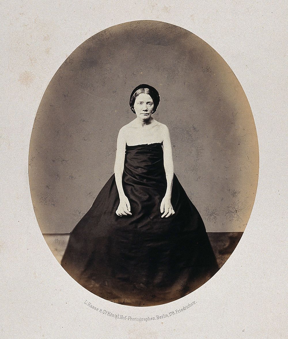 A woman standing, viewed from the front, her shoulders and arms are unclothed and she has misshapen fingers. Photograph by…