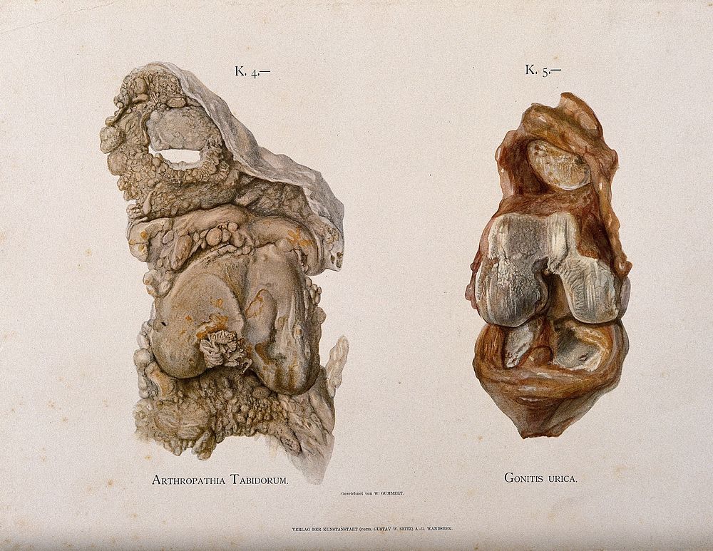 Sections of two knee joints: left, bone affected by arthropathy, right, an inflamed knee joint. Chromolithograph by W.…