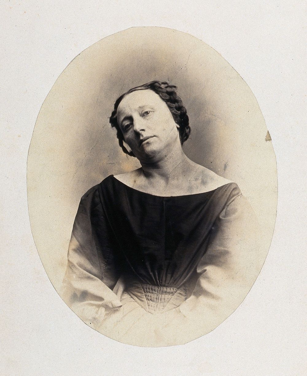 A woman, head tilted to right with bump on left shoulder. Photograph by L. Haase after H.W. Berend, 1863.