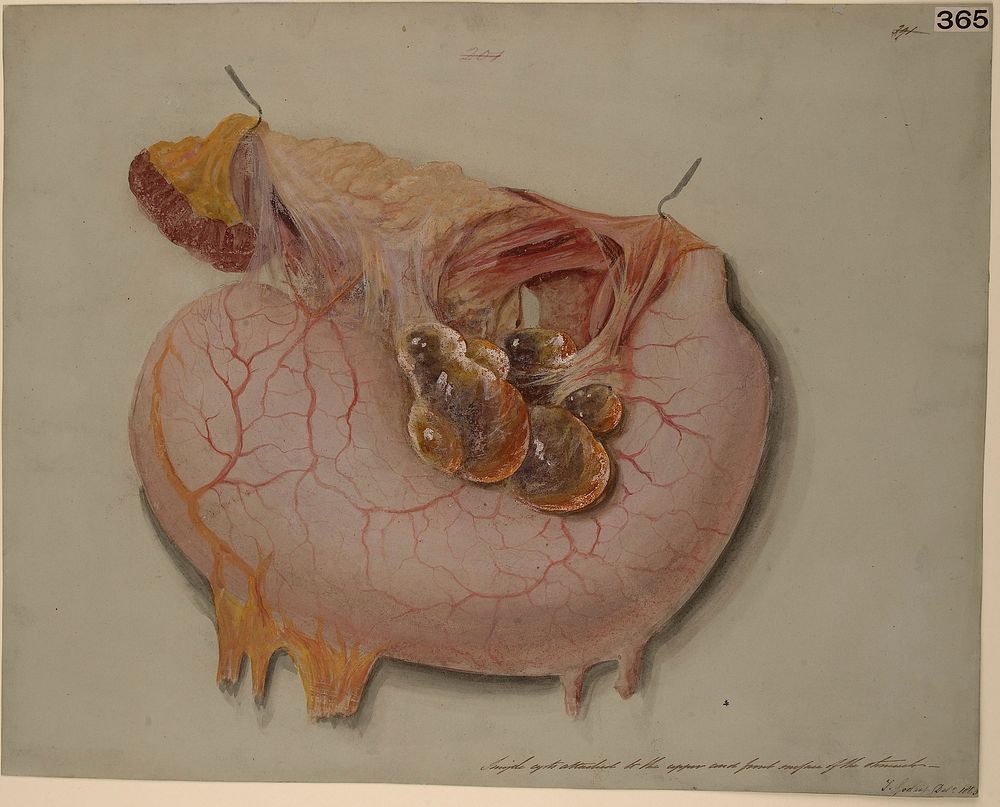 Simple cysts attached to the upper and front surface of the stomach