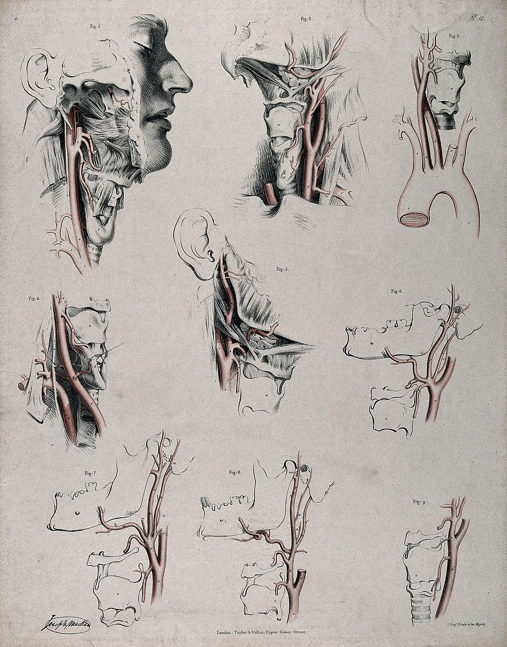 The circulatory system: dissections of the neck and jaw of a man, with arteries and blood vessels indicated in red. Coloured…