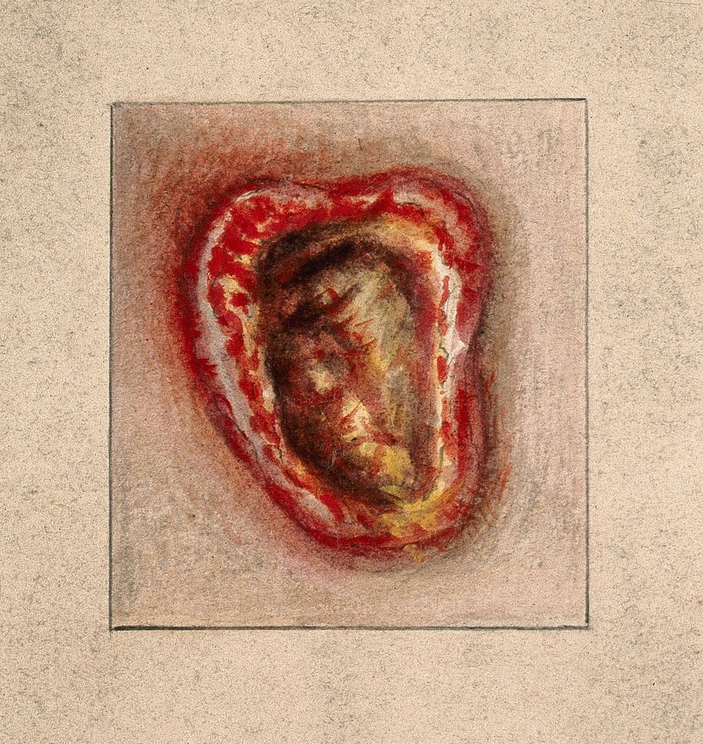 An infected sore [] on a woman's body. Watercolour by C. D'Alton, 1869.