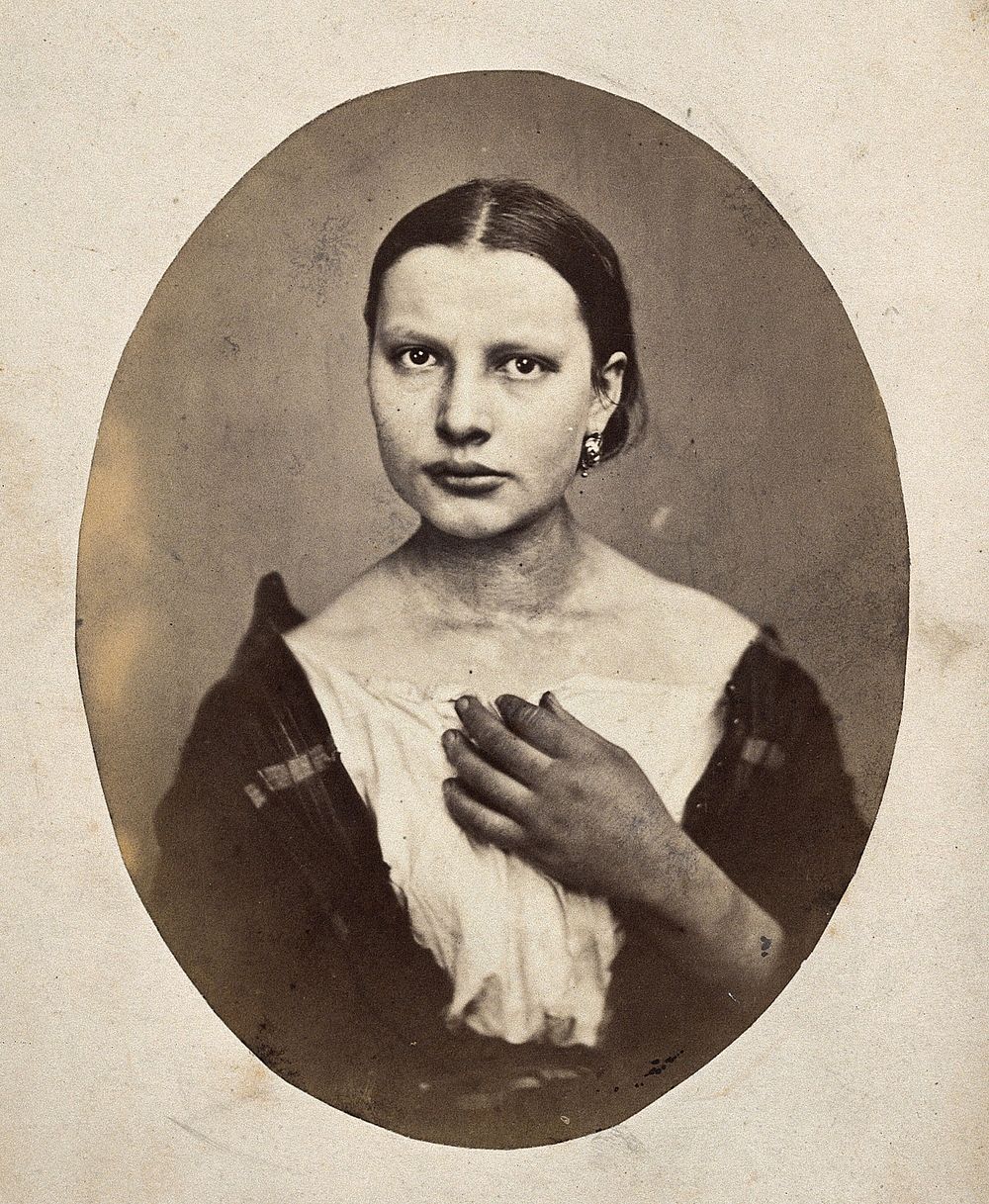 A woman, head and shoulders; she has a bump on her right shoulder. Photograph by L. Haase after H.W. Berend, 1864.