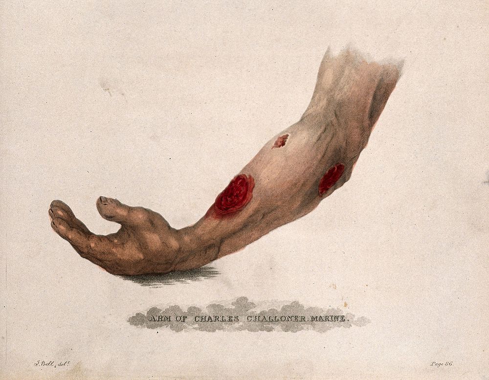A forearm with three open wounds. Coloured stipple etching after J. Bell, c. 1815 .
