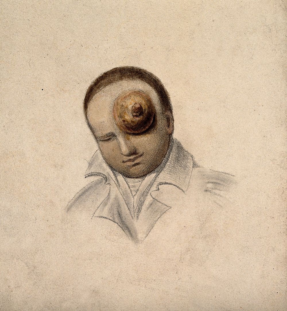 A man with a large tumour covering his eye. Coloured lithograph.