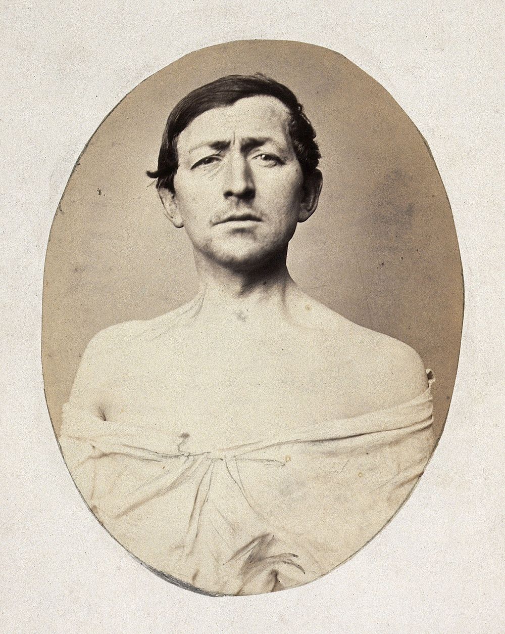 A man, head and shoulders; his shirt undone. Photograph by L. Haase after H.W. Berend, 1863.
