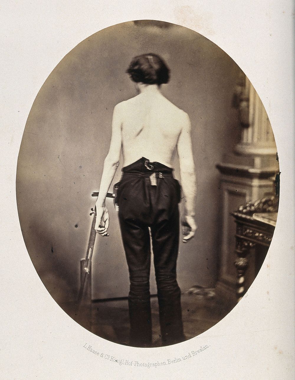A young man, standing, unclothed to the waist and viewed from behind; his left arm appears deformed. Photograph by L. Haase…