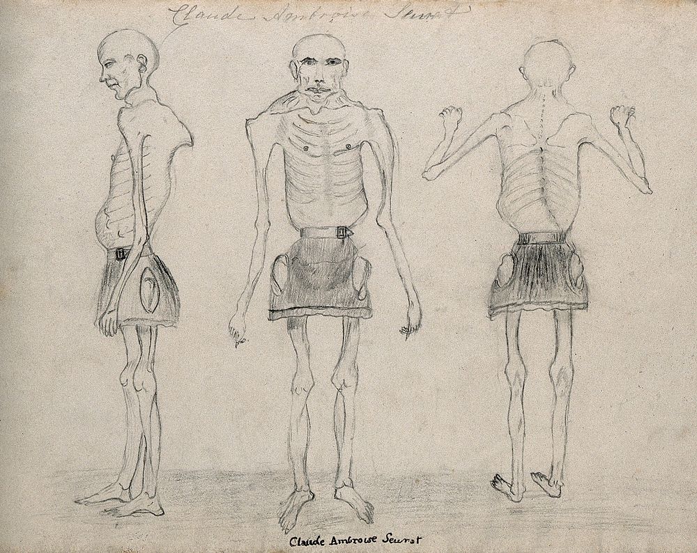Claude Ambroise Seurat, a very thin man who was known as the 'Human Skeleton'. Drawing.