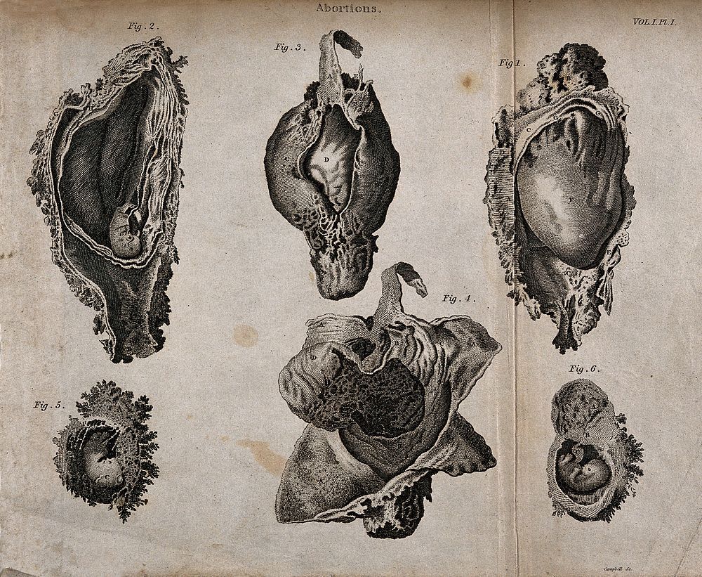 Six diagrams of abortions at different stages. Engraving by Campbell.