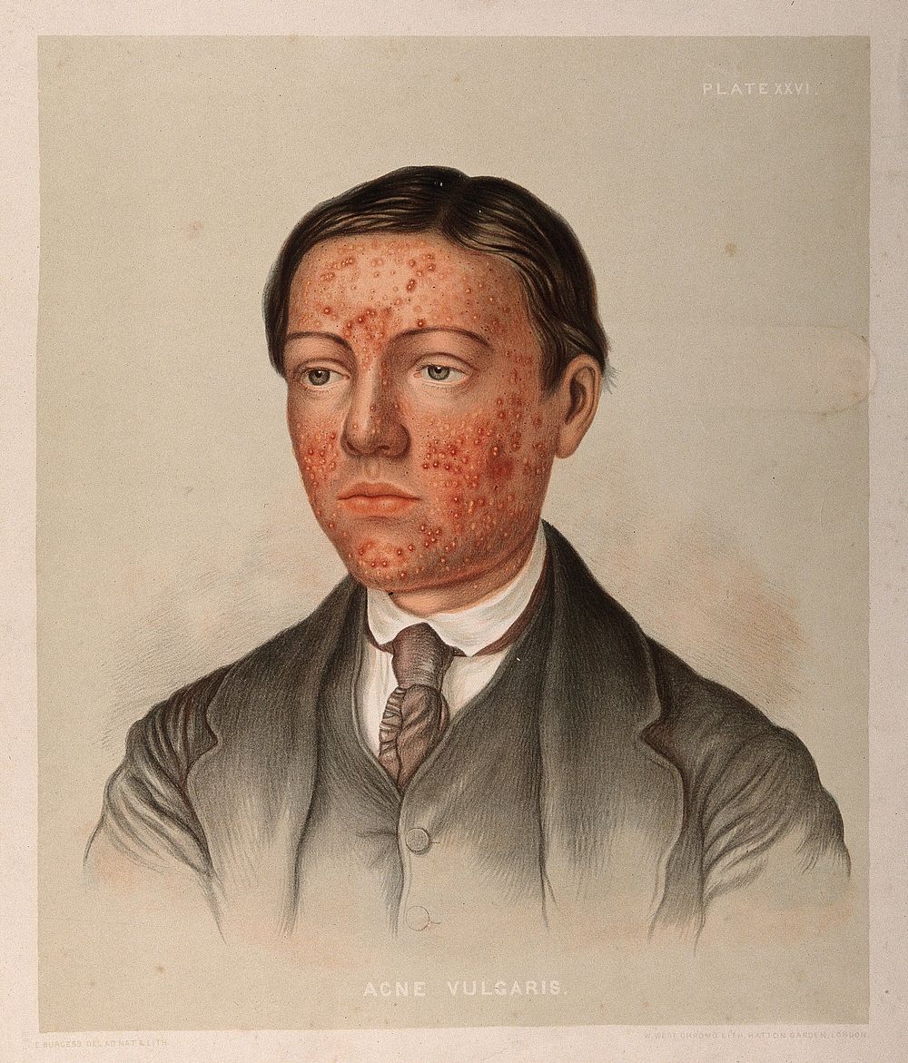 Skin on the face of a young man suffering from acne vulgaris. Chromolithograph by E. Burgess, 1850/1880.
