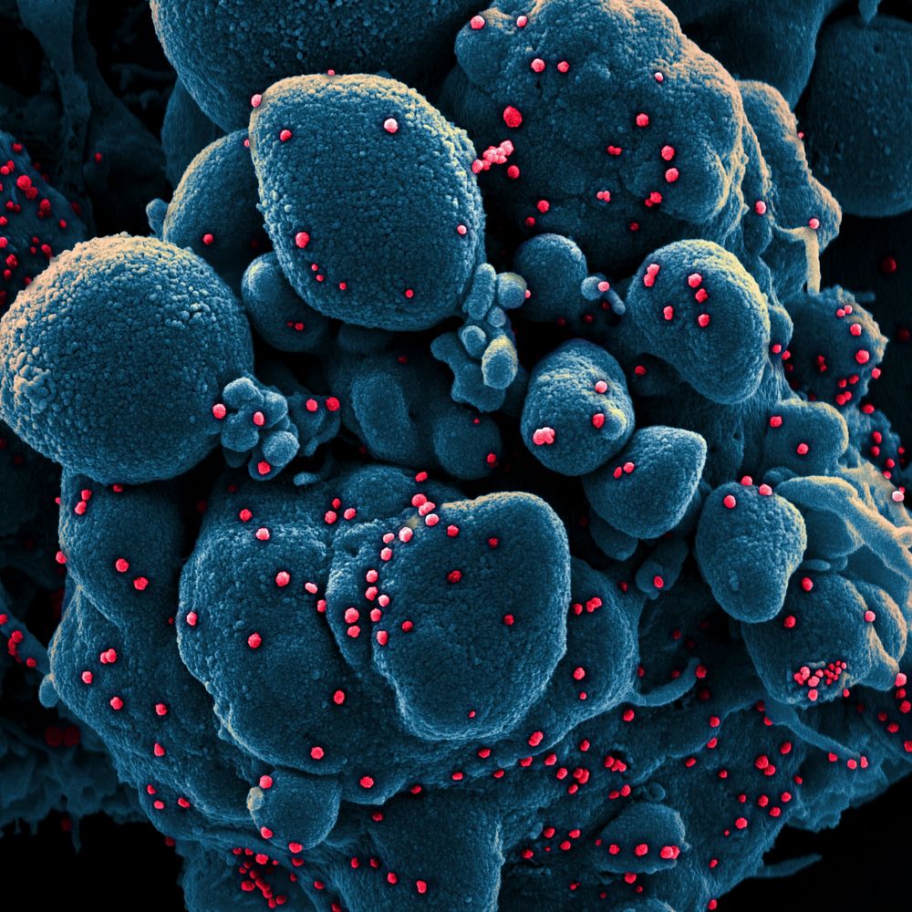 Novel Coronavirus SARS-CoV-2&ndash;Colorized scanning electron micrograph of an apoptotic cell (blue) infected with SARS-COV…