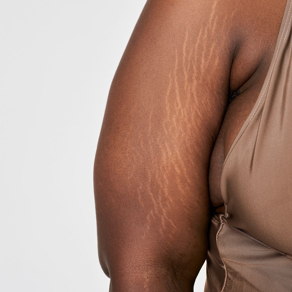 Plus-size woman arm's stretch mark, body positivity concept