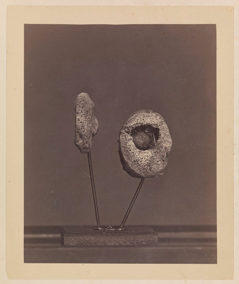 Excised Knee Joint. A Round Musket Ball in the Inner Condyle of the Right Femur [Gardiner Lewis, Company B, Nineteenth…