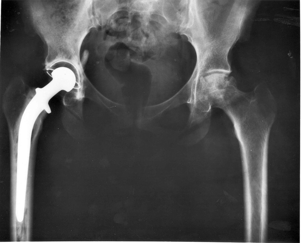 An A-P X-ray of a pelvis showing a total hip joint replacement. The right hip joint (on the left in the photograph) has been…