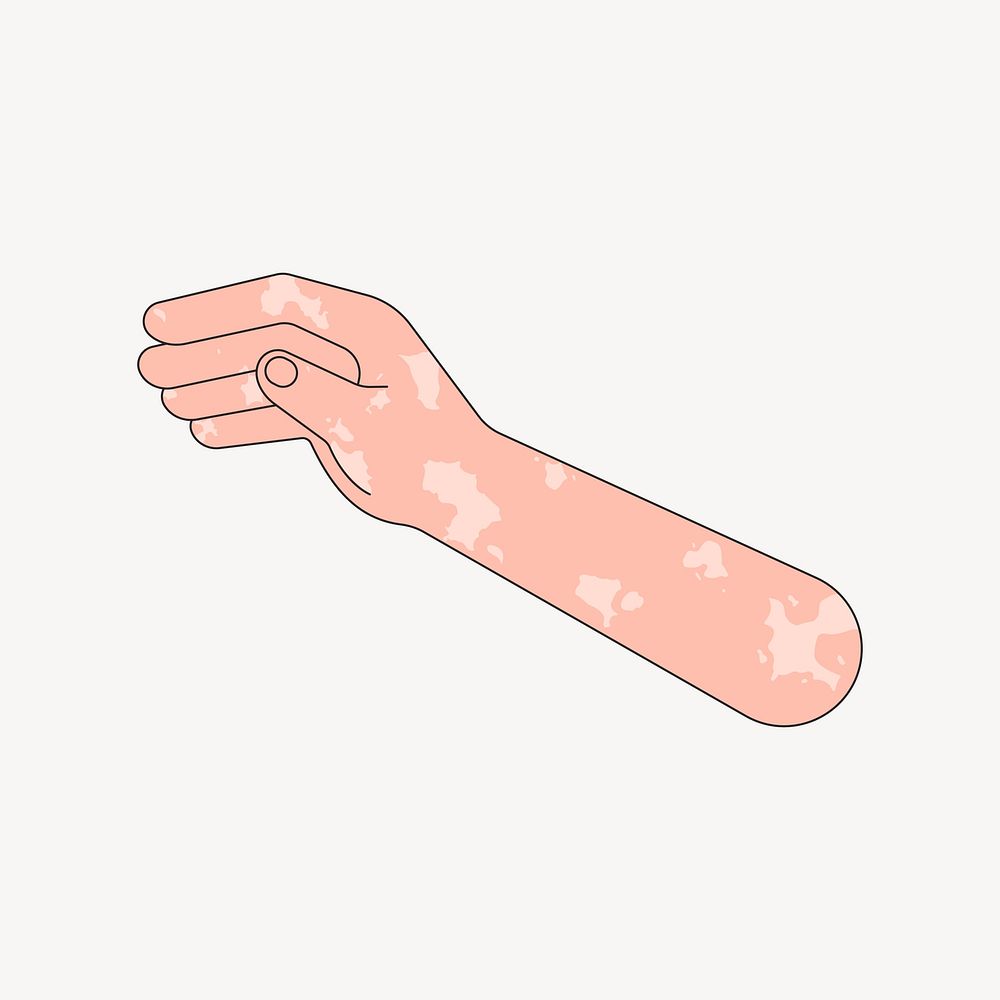 Vitiligo hand arm, gesture flat illustration
