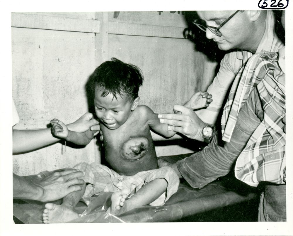 Dr. Mackler examines crying Vietnamese child with large lesion on his chest.  Mackler, with the aid of an assistant and the…